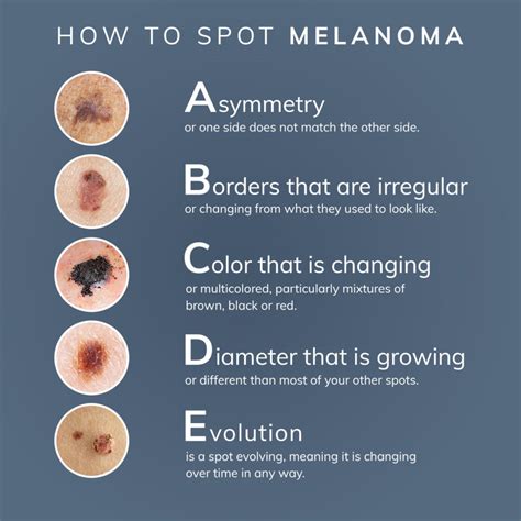 What you need to know about checking for and identifying melanoma